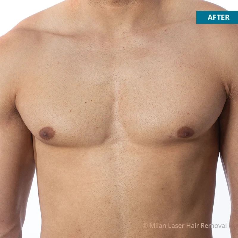 Laser Hair Removal