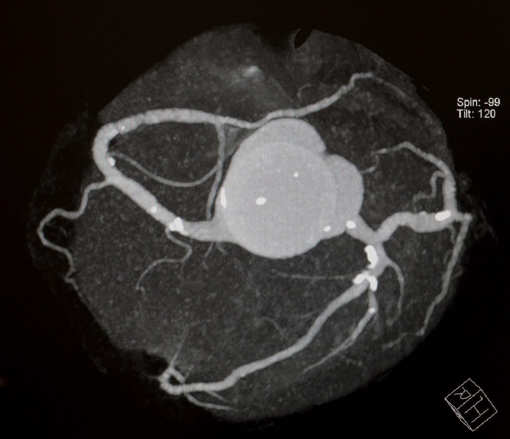Calcium Heart Score