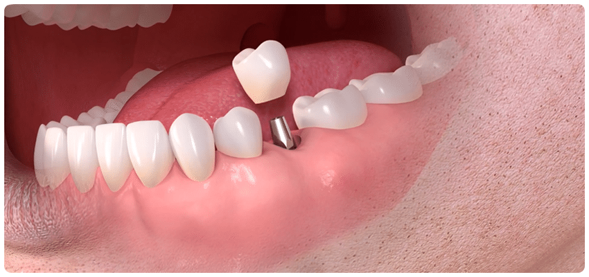 Dental Implants in Turkey