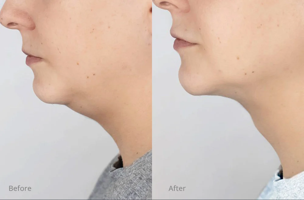 Liposuction in Dubai