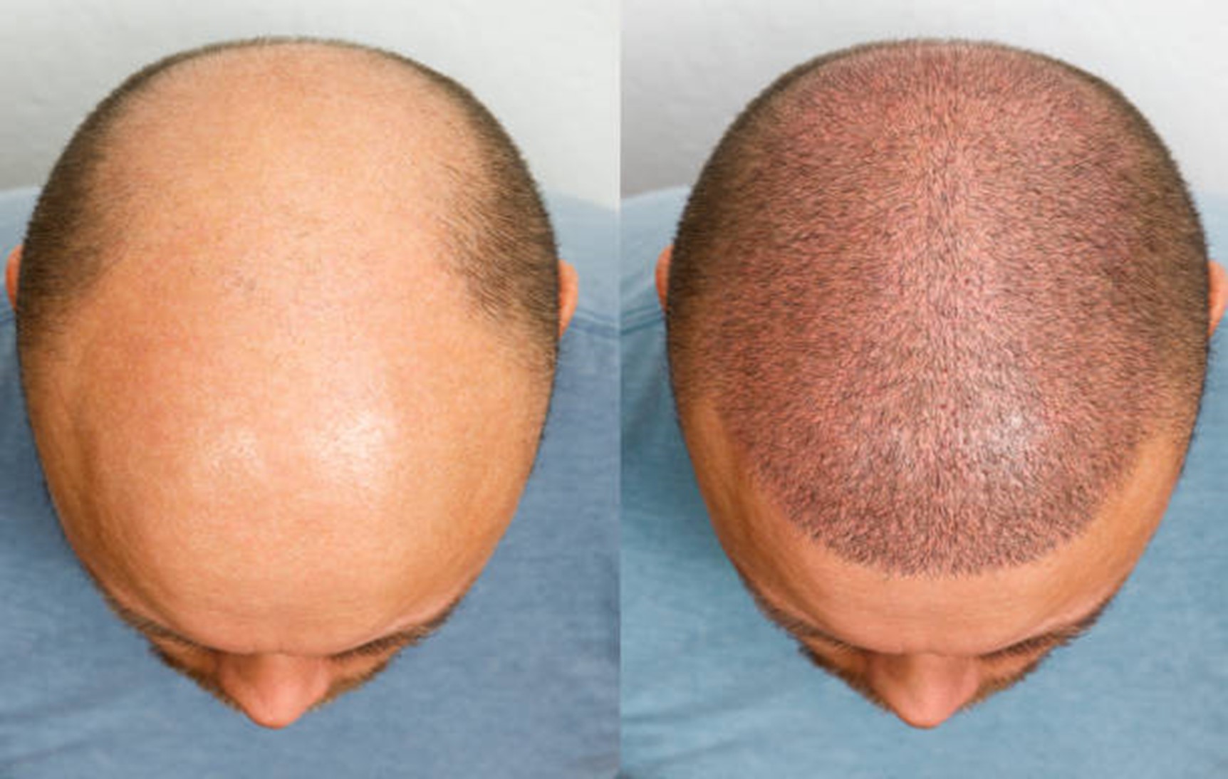 Hair Transplants