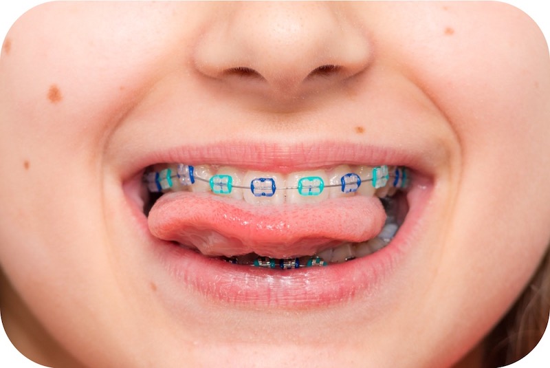Pediatric Orthodontics