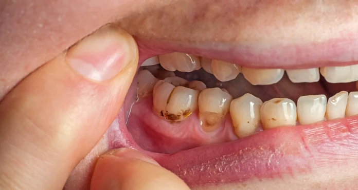 Tooth Pain