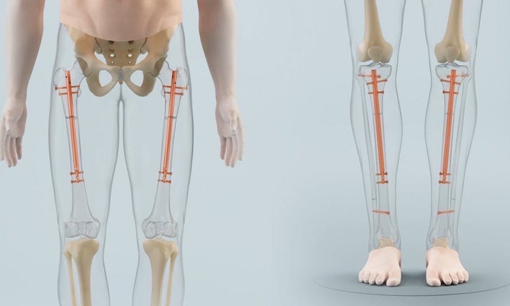 Lengthening Surgery