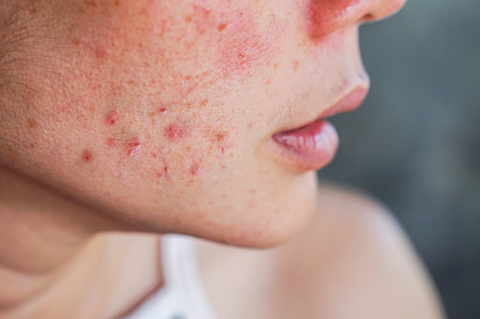 Zits, Stress, and Weird Skin Stuff: Here’s What Actually Helps
