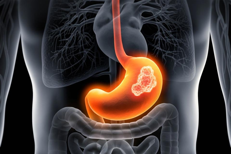 Stomach Problems